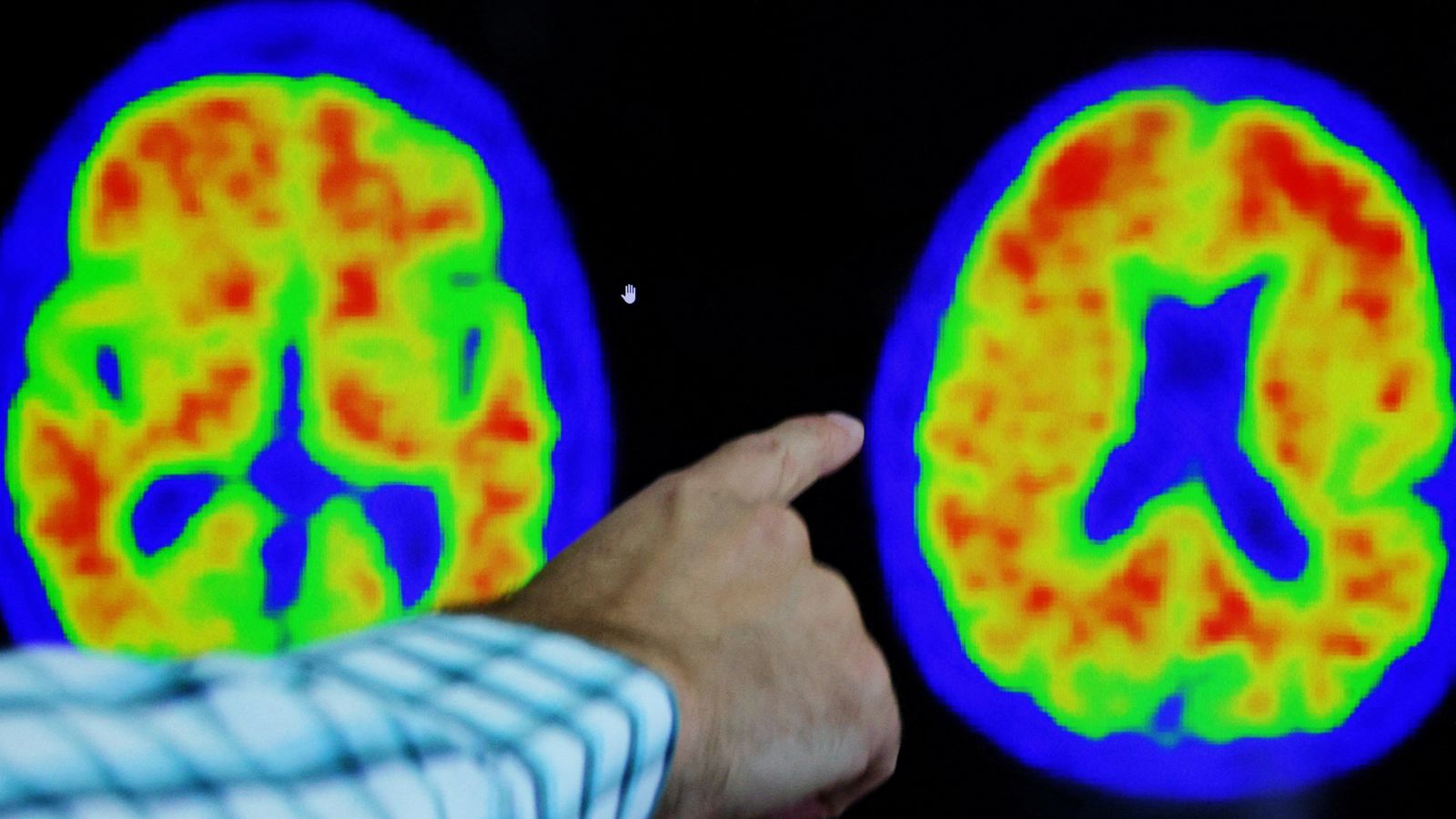 Fillimi i fundit të Alzheimerit? Zbulohet ilaçi i ri që mund të trajtojë sëmundjen